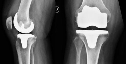 Oro y Titanio: nuevo avance en implantes médicos