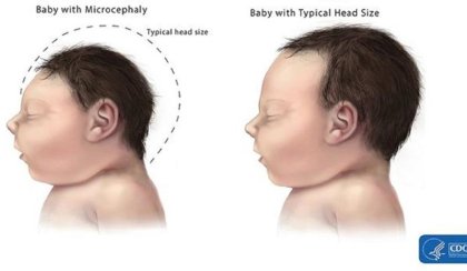 Insecticida ligado a Monsanto podría ser la causa de los casos de microcefalia por virus zika