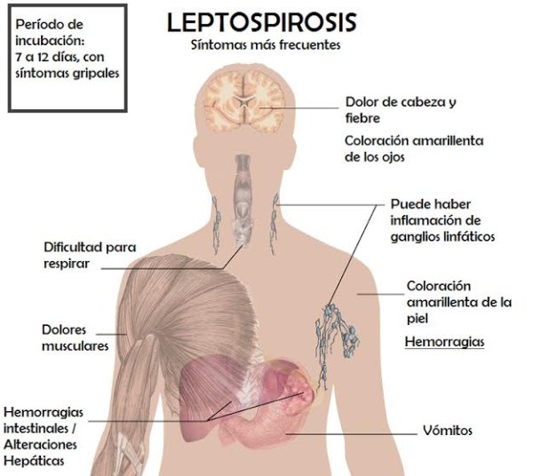 ¿Qué es la leptospirosis?